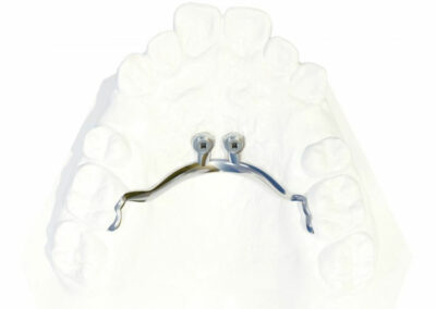 A3DB10-3-Ancrage dentaire incisif ou molaire