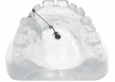 A3DB13-Bras de traction de canines incluse ou de dent en retard d’éruption