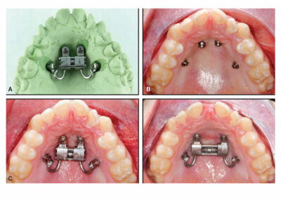 A3DB3-Expander sur 4 minivis benefit