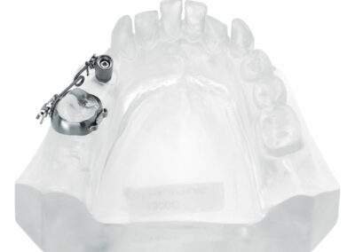 A3DB9-Minivis pour redresser les axes des molaires