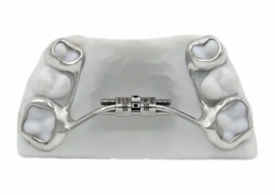 AF2-Disjoncteur palatin sur 4 bagues