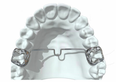 AF6-2-Arc lingual / palatin soudé ou amovible 2