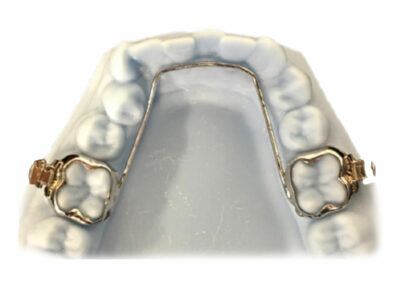 AF6-Arc lingual / palatin soudé ou amovible