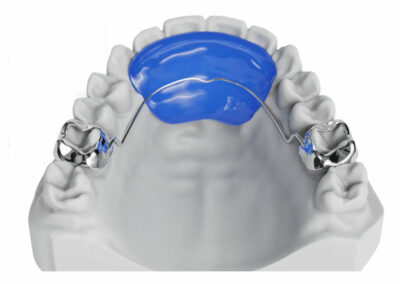 AF8-2-Arc palatin avec plan rétro-incisif 2