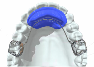 AF8-Arc palatin avec plan rétro-incisif