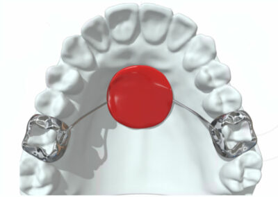 AF9-2-Mainteneur d'espace avec et sans ressort 2