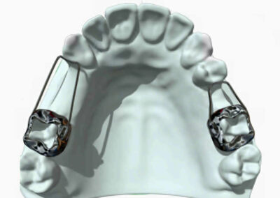 AF9-Mainteneur d'espace avec et sans ressort