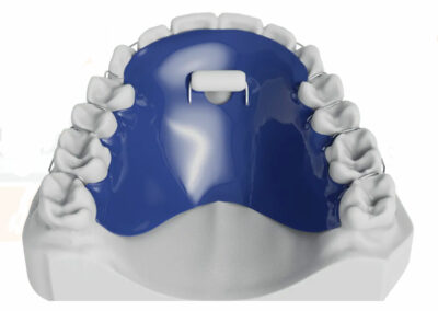 AM1-2-Plaque de Hawley