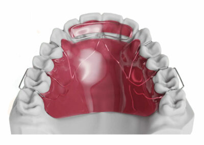 AM1-Plaque de Hawley