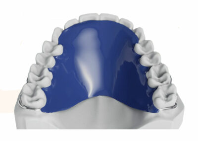 AM4-2-Plaque avec plan rétroincisif