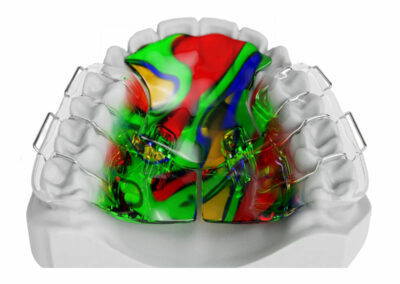 AM4-Plaque avec plan rétroincisif