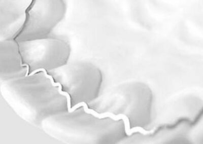 Appareil de contentions orthodontiques