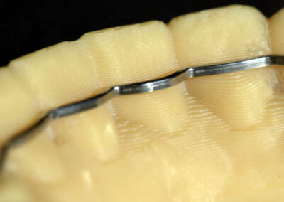 Appareil de contentions orthodontiques