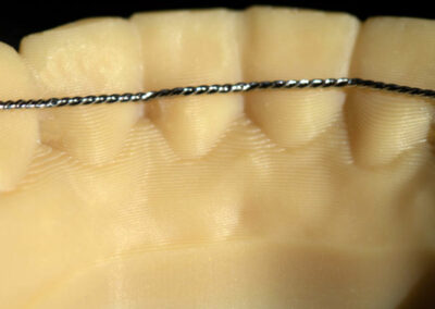 Appareil de contentions orthodontiques