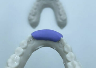 Appareil de contentions orthodontiques